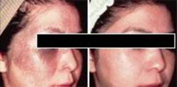 Latest PICO Laser for Pigmentary disorders