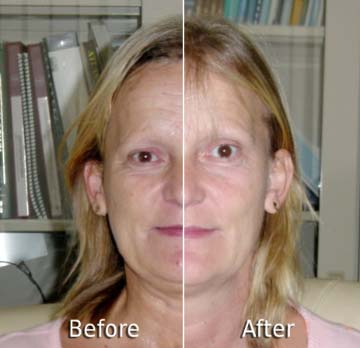 RF Micro Needle Fractional