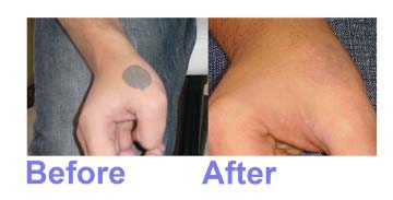 Tattoo removal by PICO Laser
